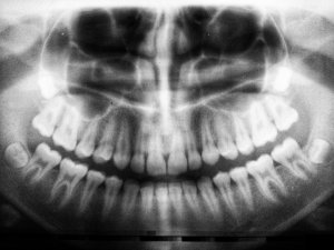 X-ray of full set of human teeth